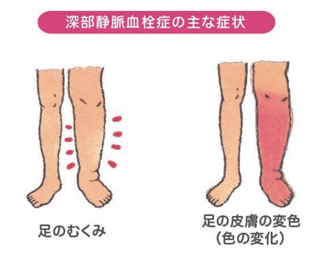 表在性血栓静脈炎の症状は何ですか?